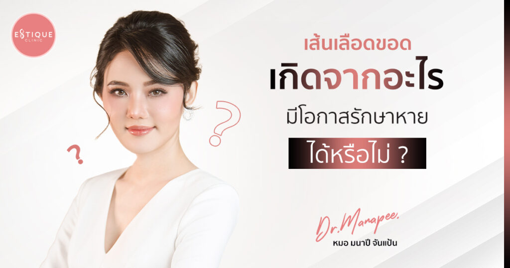 เส้นเลือดขอดเกิดจากอะไร